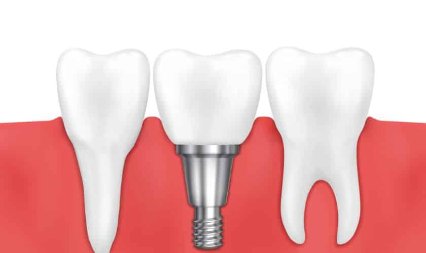 Dental Implants in Covington, WA
