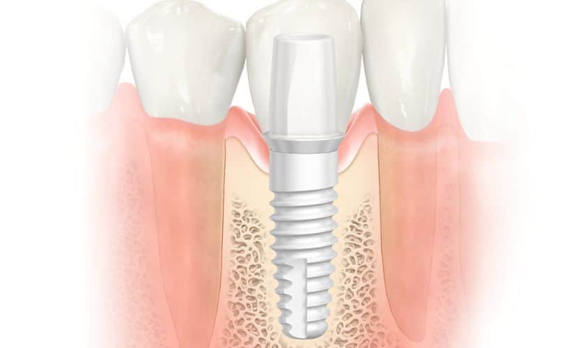 Reasons You Should Consider Getting Metal Free Dental Implants