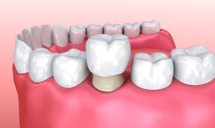 Metal free dental implant in Covington, WA