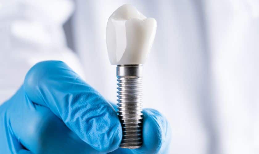 Step By Step Guide To The Dental Implant Procedure In Covington