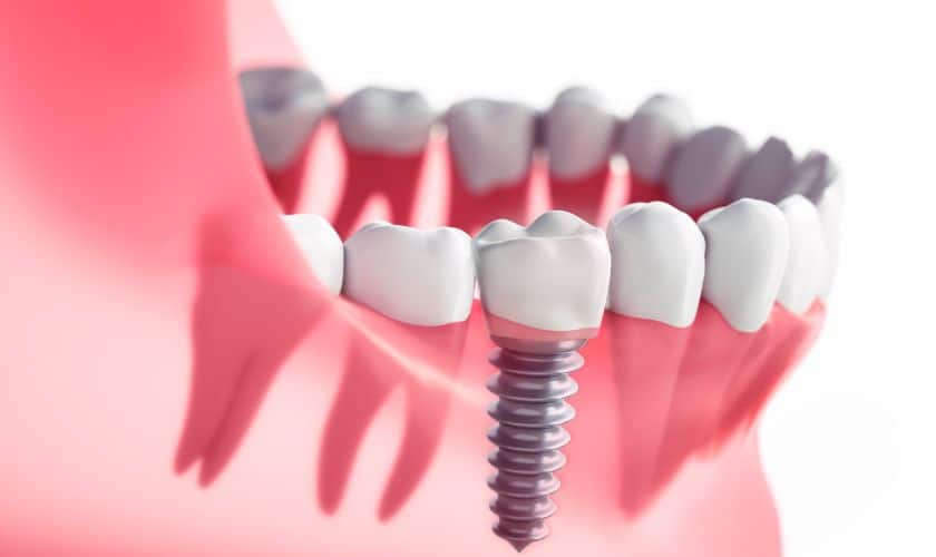 Dental Implants Covington