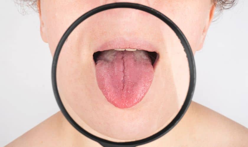 Stages of Oral Cancer