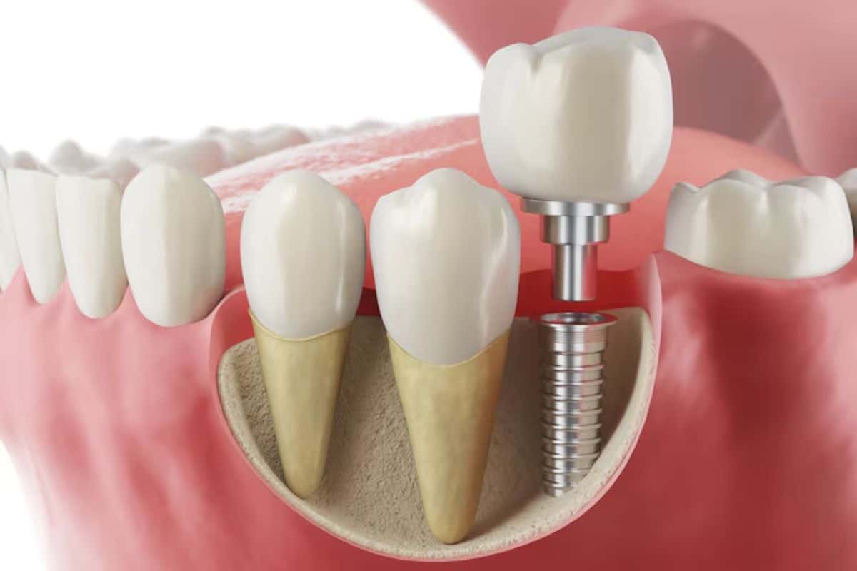 Is There a Non-metal Tooth Implant