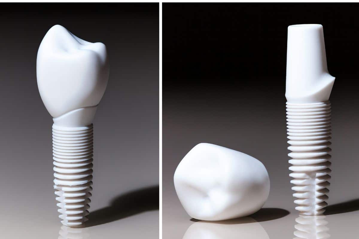 Metal-Free Dental Implants