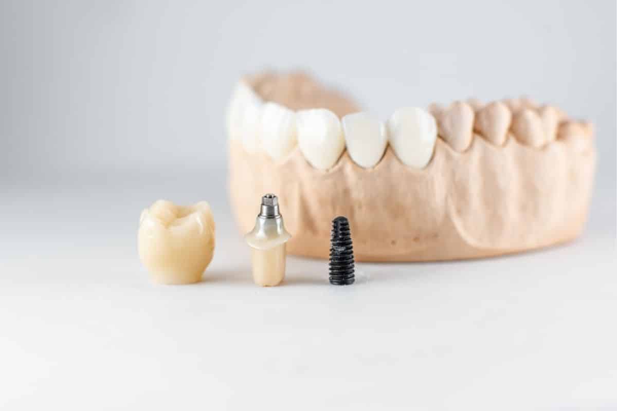 dental implants