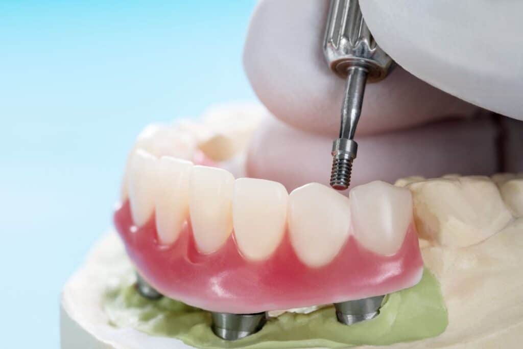 Dental Implant Surgery as a Diabetic Patient