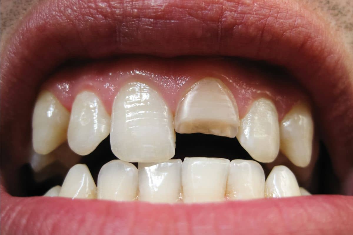Broken Tooth