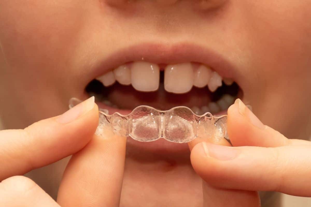 invisalign covington