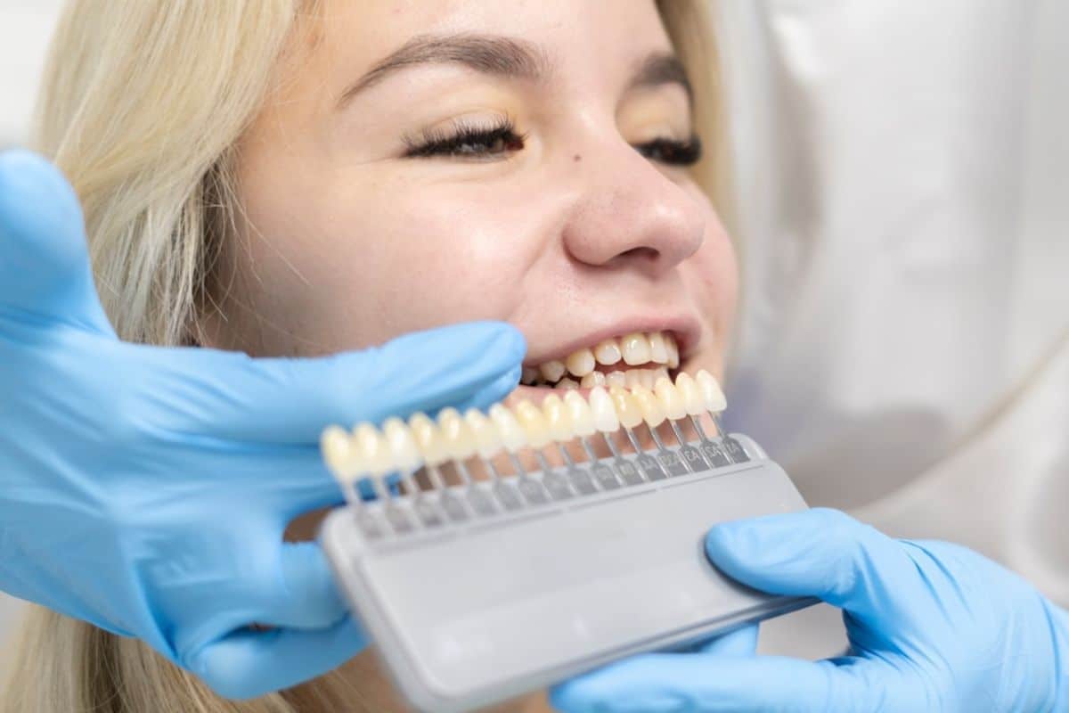 Dental Veneers