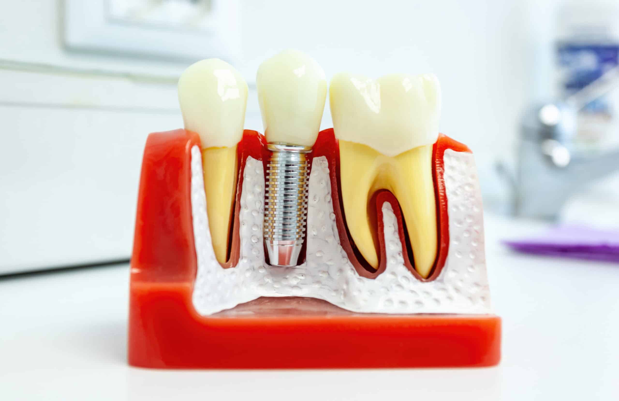 dental implants
