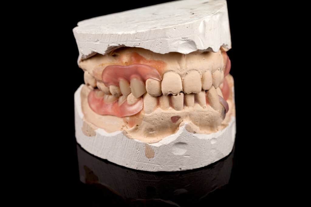 Signs You Need New Dentures