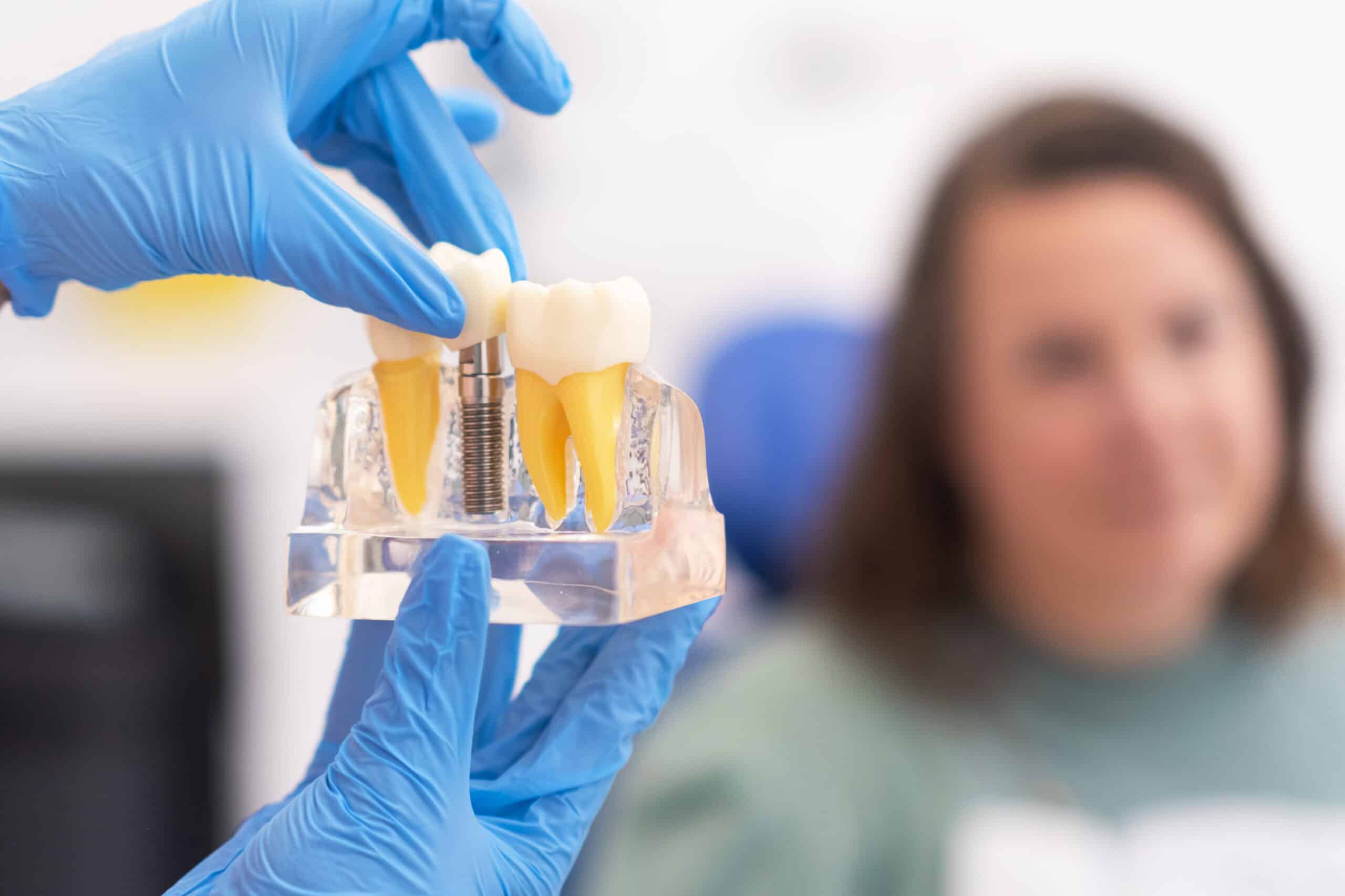 dental implants