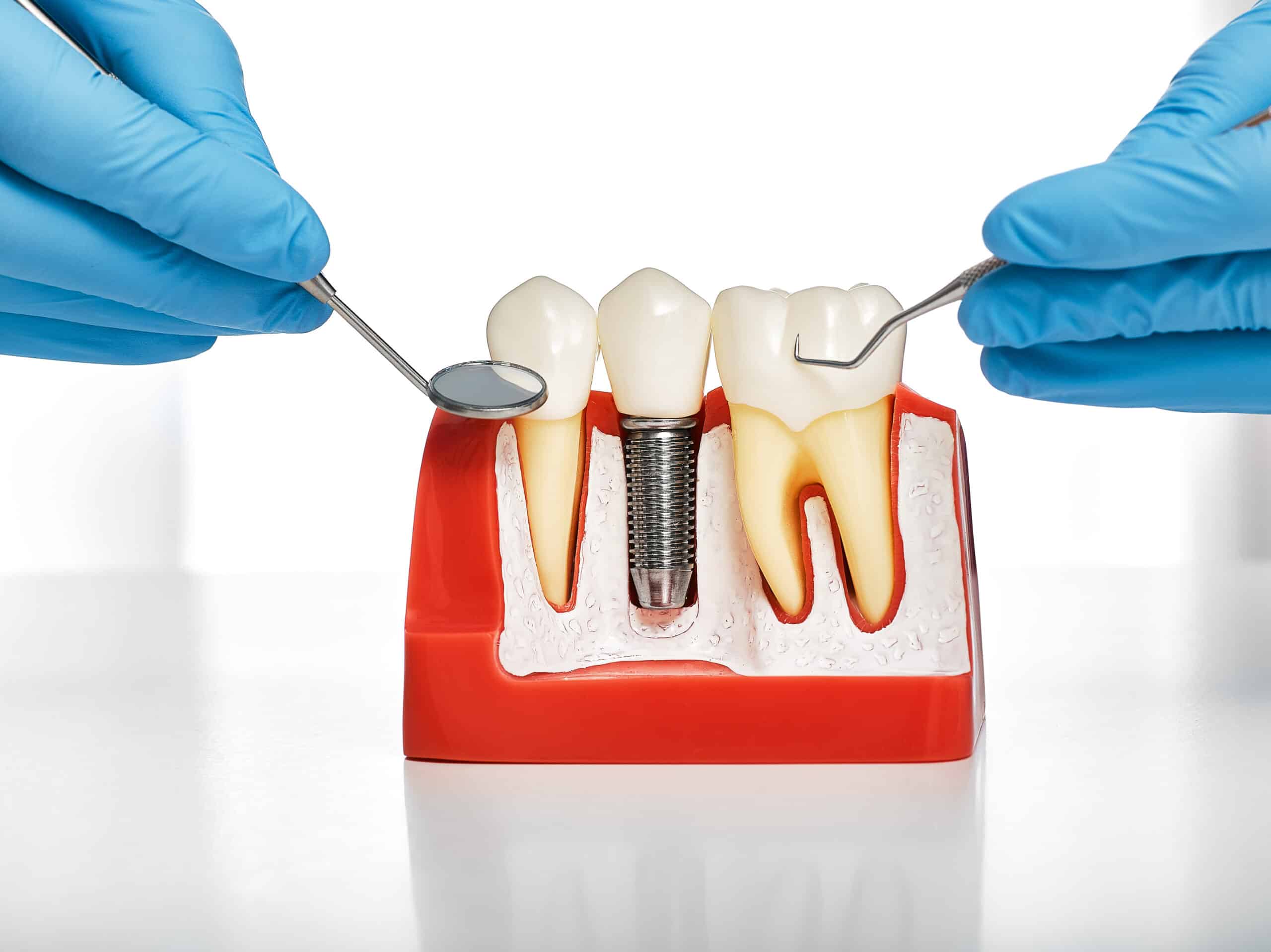 dental implants in covington