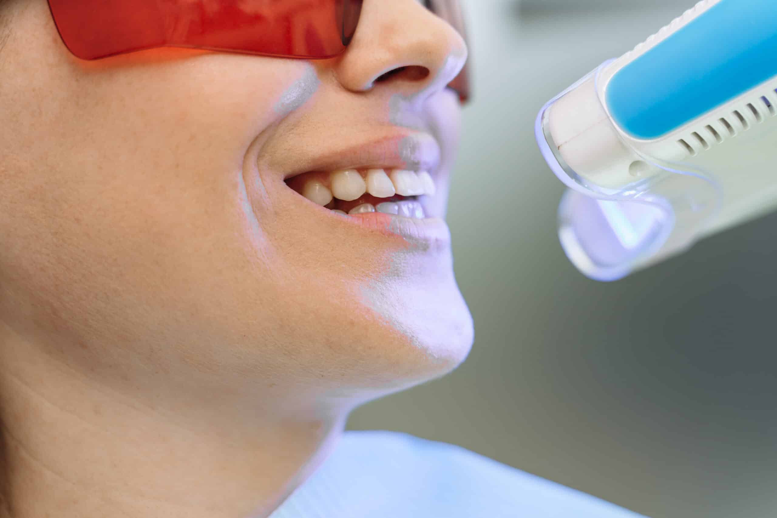 teeth whitening