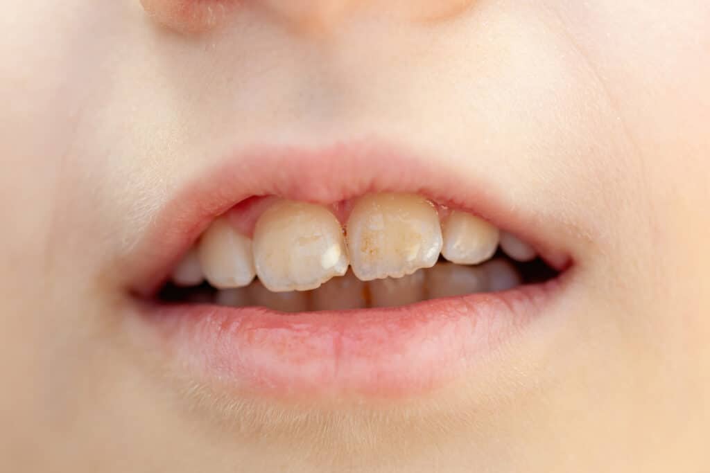 spot on teeth