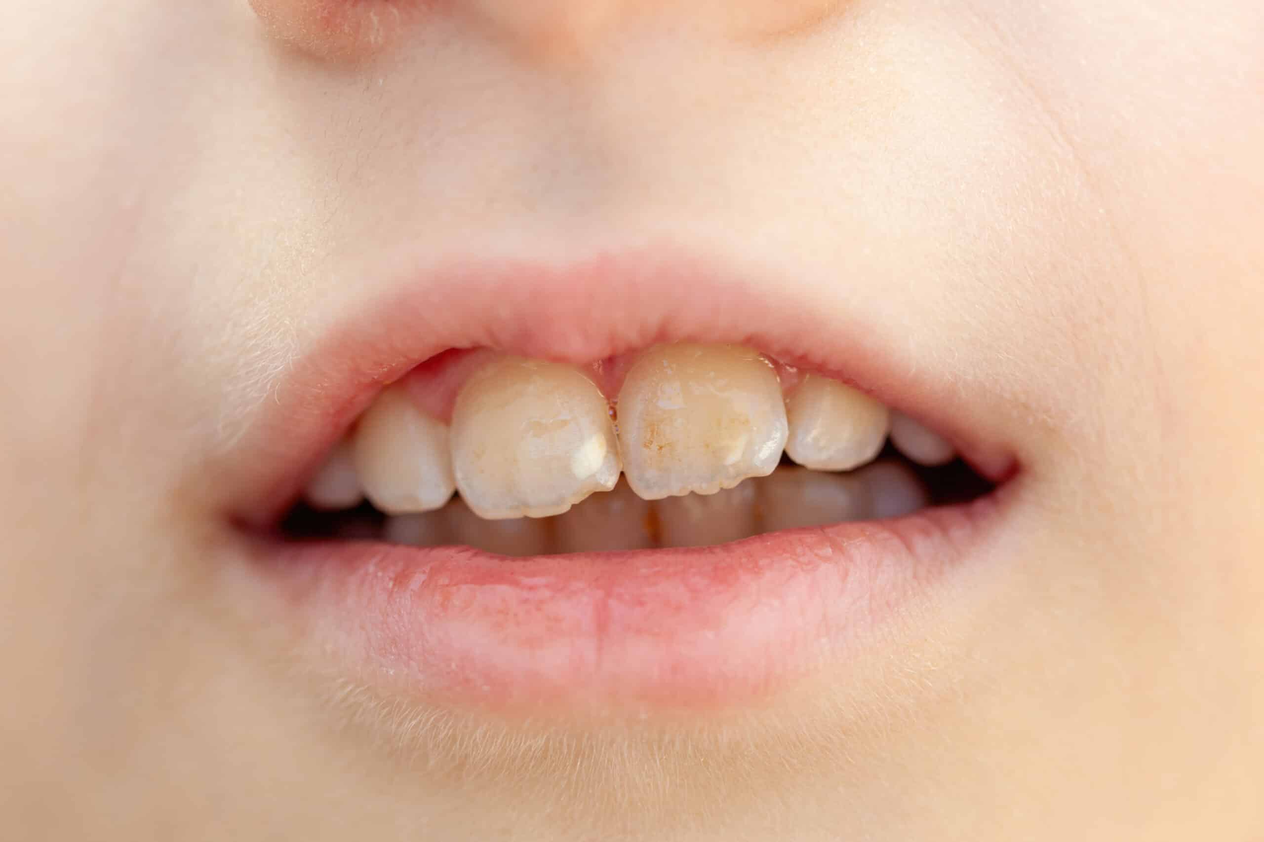 spot on teeth