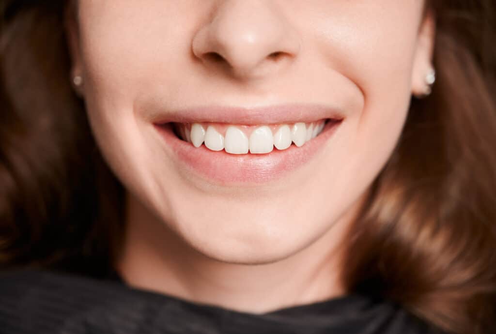 teeth whitening