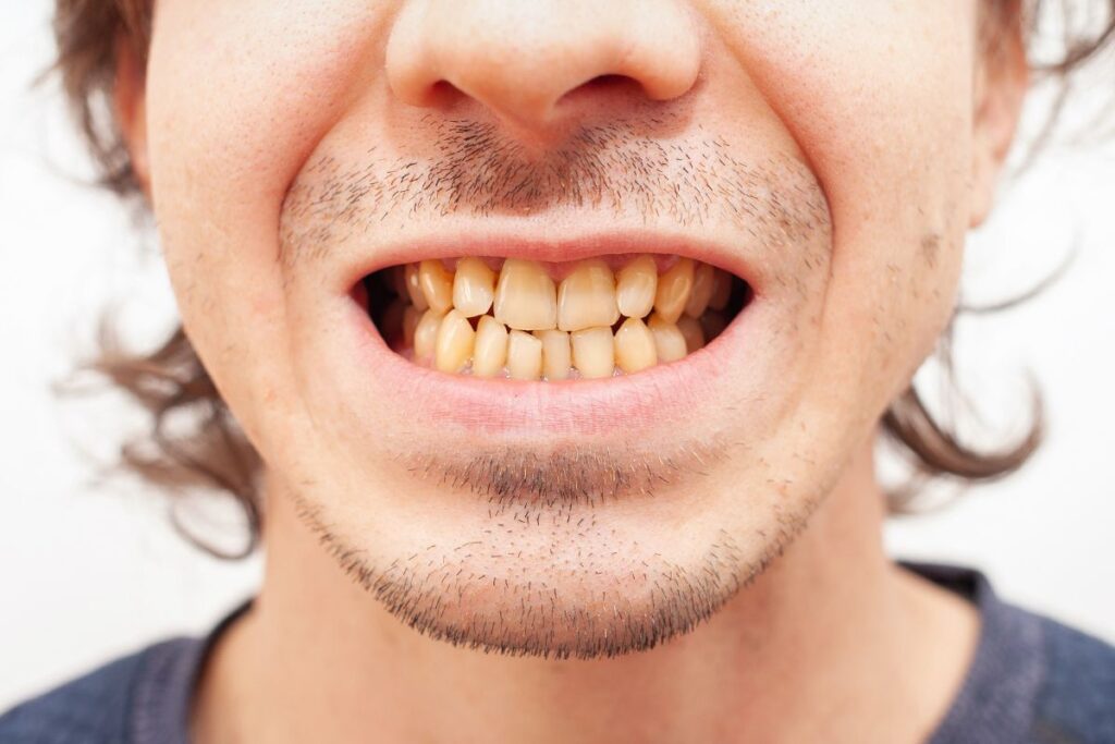 white spots on teeth