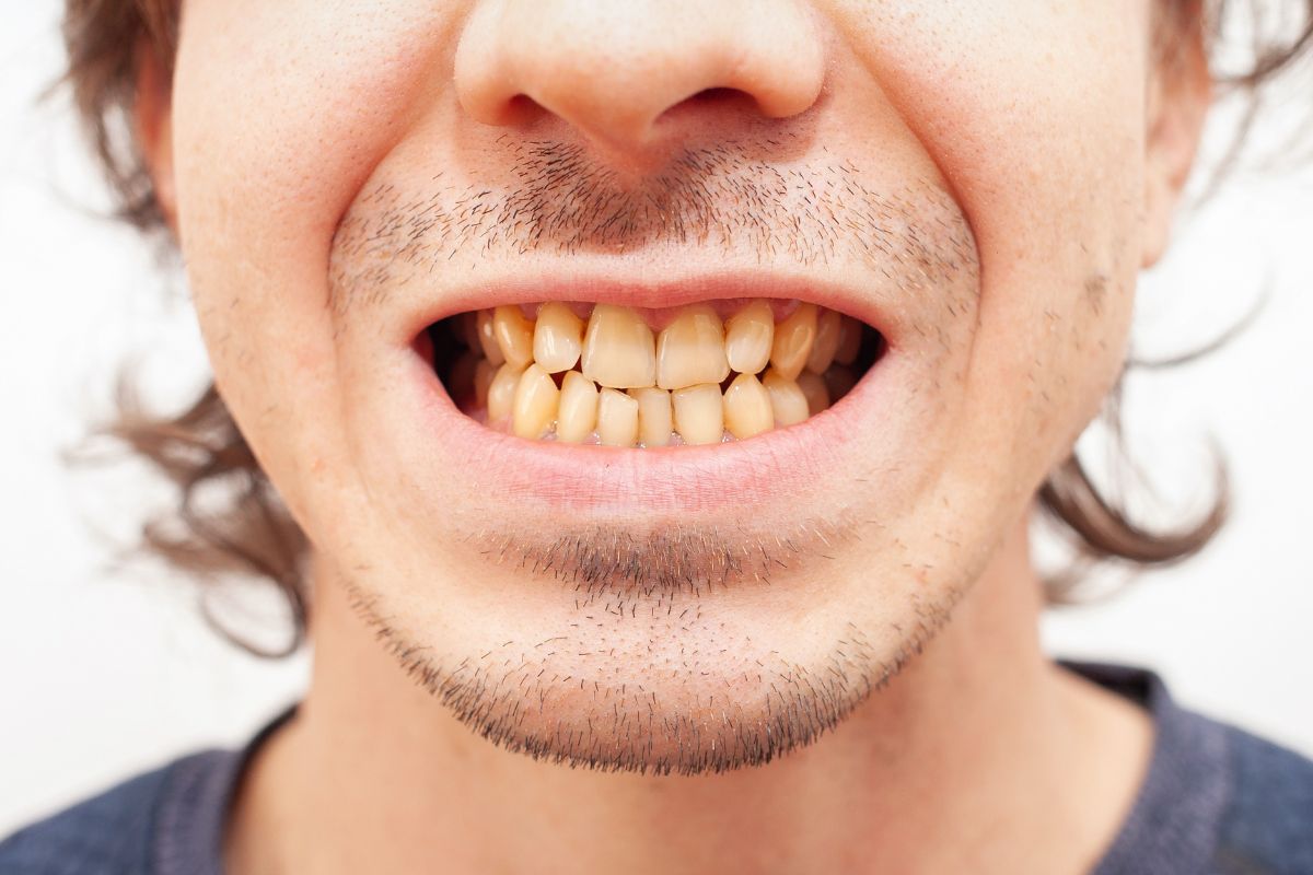white spots on teeth