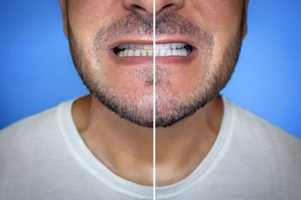 close up of a man s mouth before and after teeth