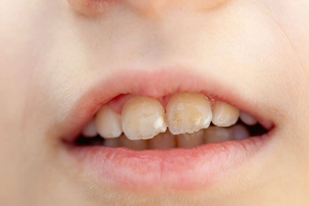 Teeth Whitening Fix Tetracycline Stains