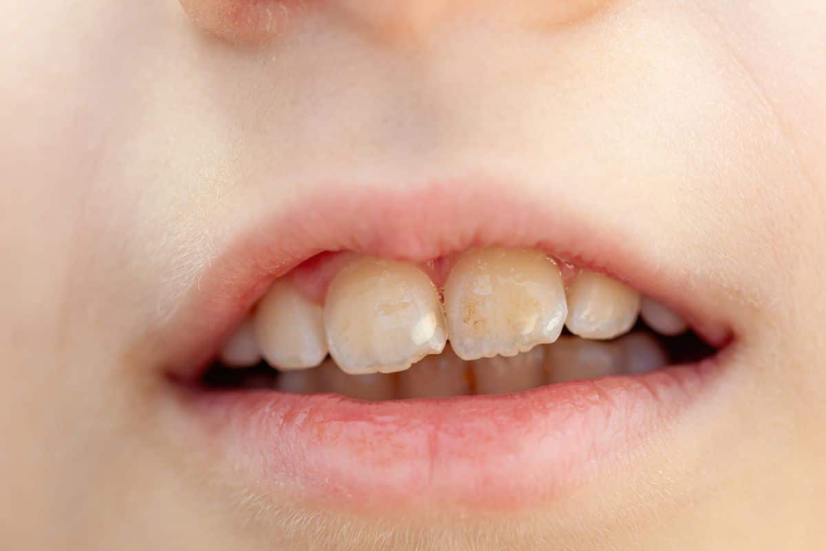 Teeth Whitening Fix Tetracycline Stains