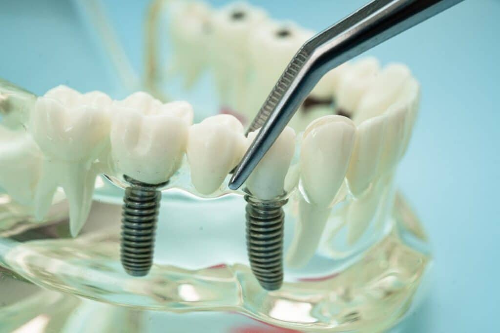 dental implants