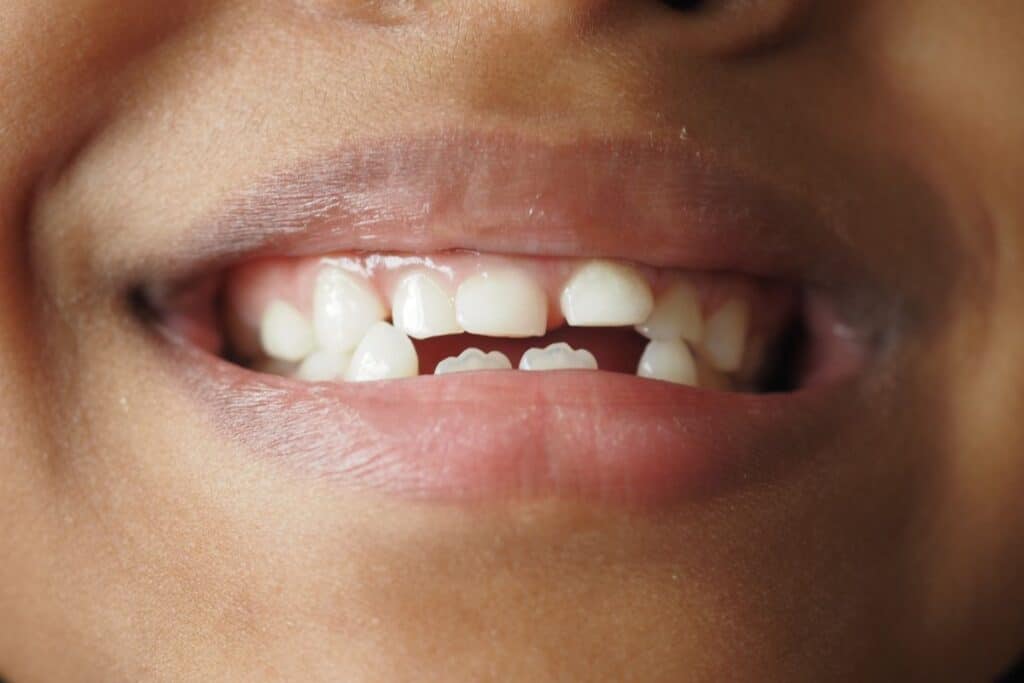 Peg teeth