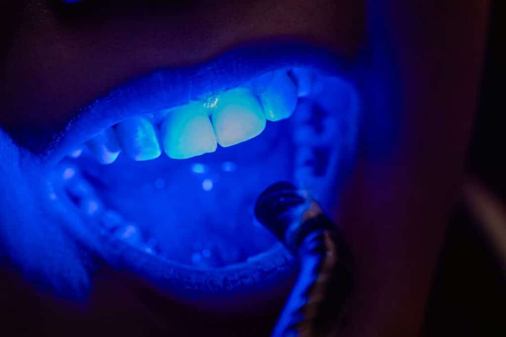 teeth whitening