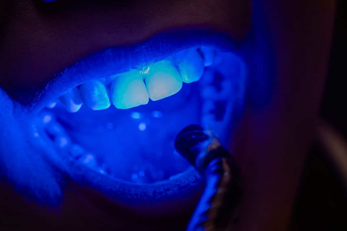 teeth whitening
