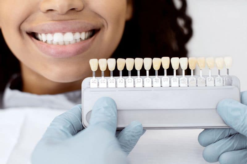 Do Veneers Stain Easily
