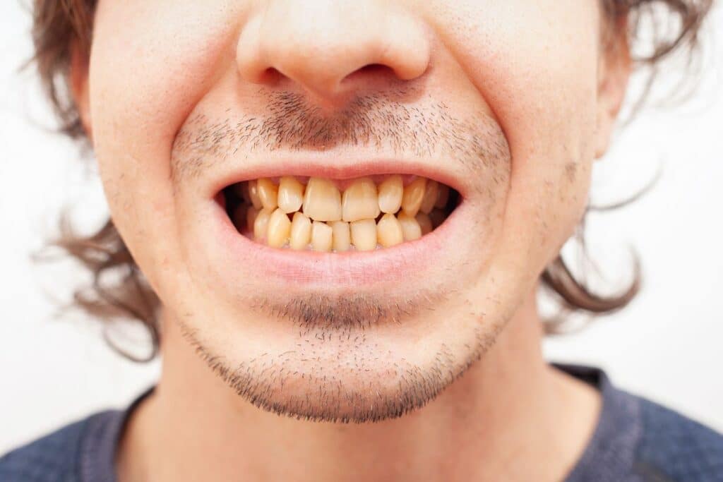 yellow teeth