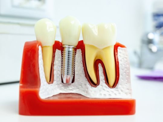 dental implant model