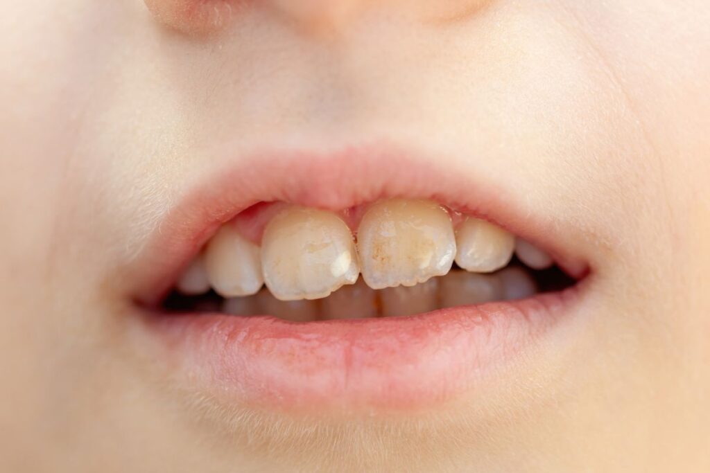 white spots on teeths