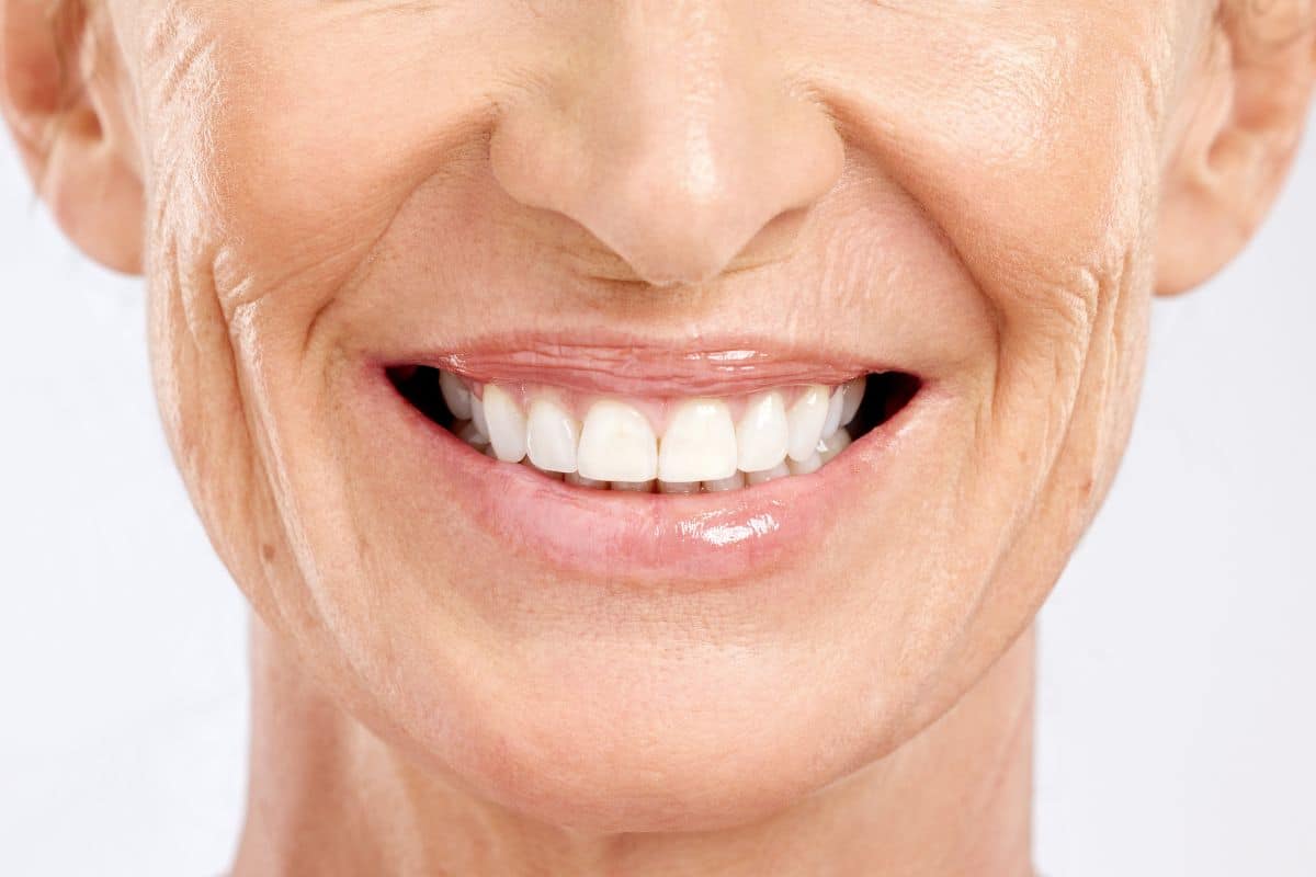 Whiten Teeth After Getting Veneers
