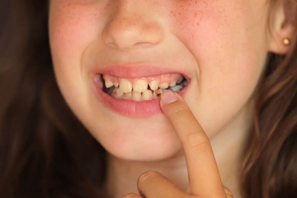 Cavities on Your Front Teeth
