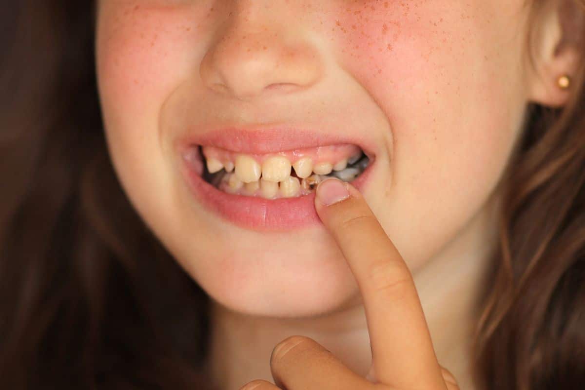 Cavities on Your Front Teeth