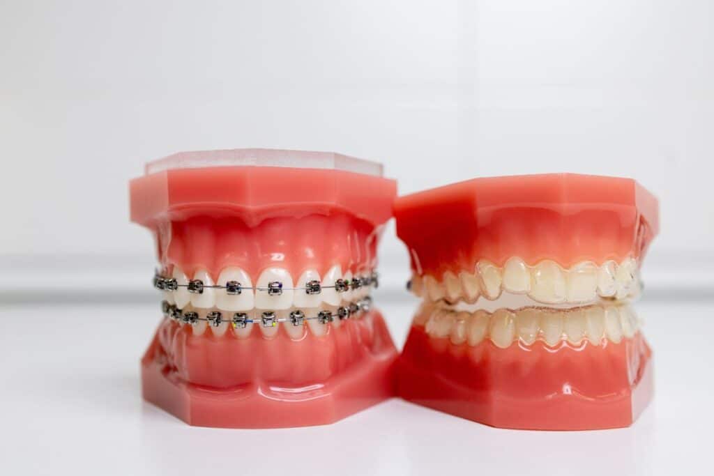 Invisalign Replace Braces in Complex Orthodontic Cases