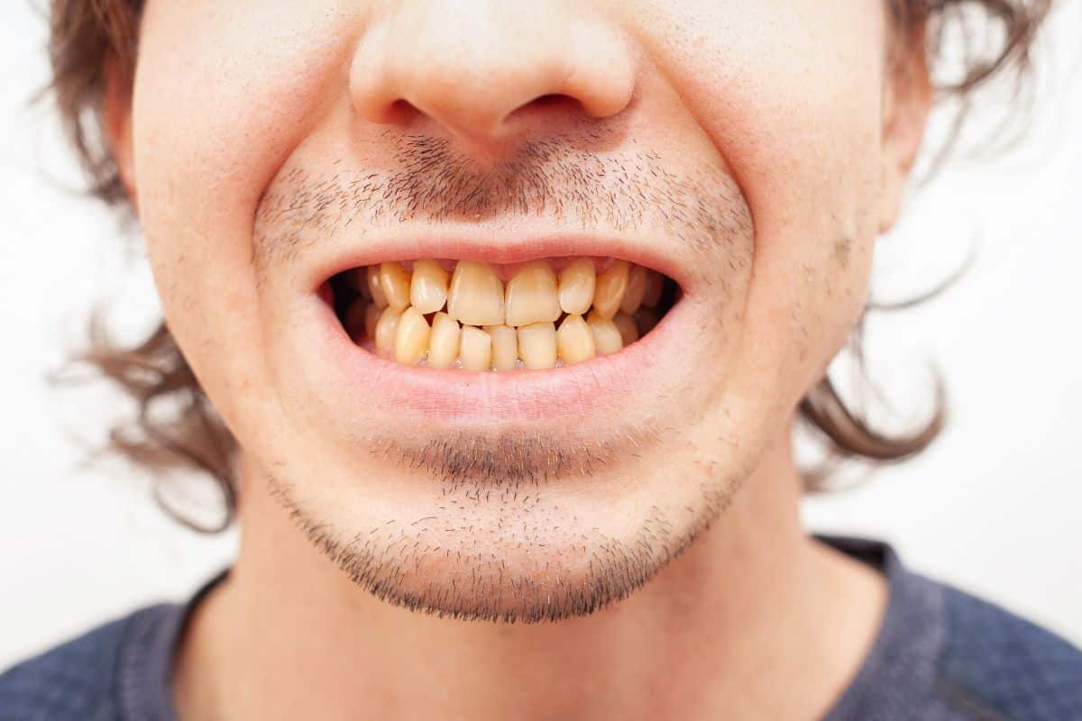 Teeth Stay Yellow After Professional Whitening